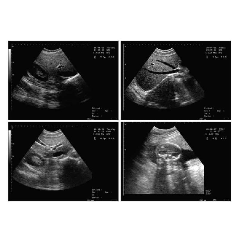 Portable all-digital notebook medical ultrasound scanner + convex array probe